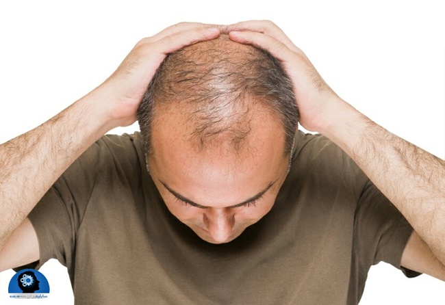 تقویت موی سر مردان