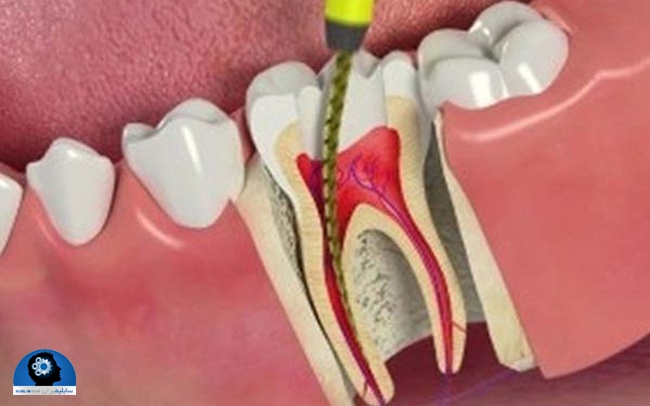 دندان درد عصبی