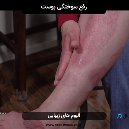رفع سوختگی پوست